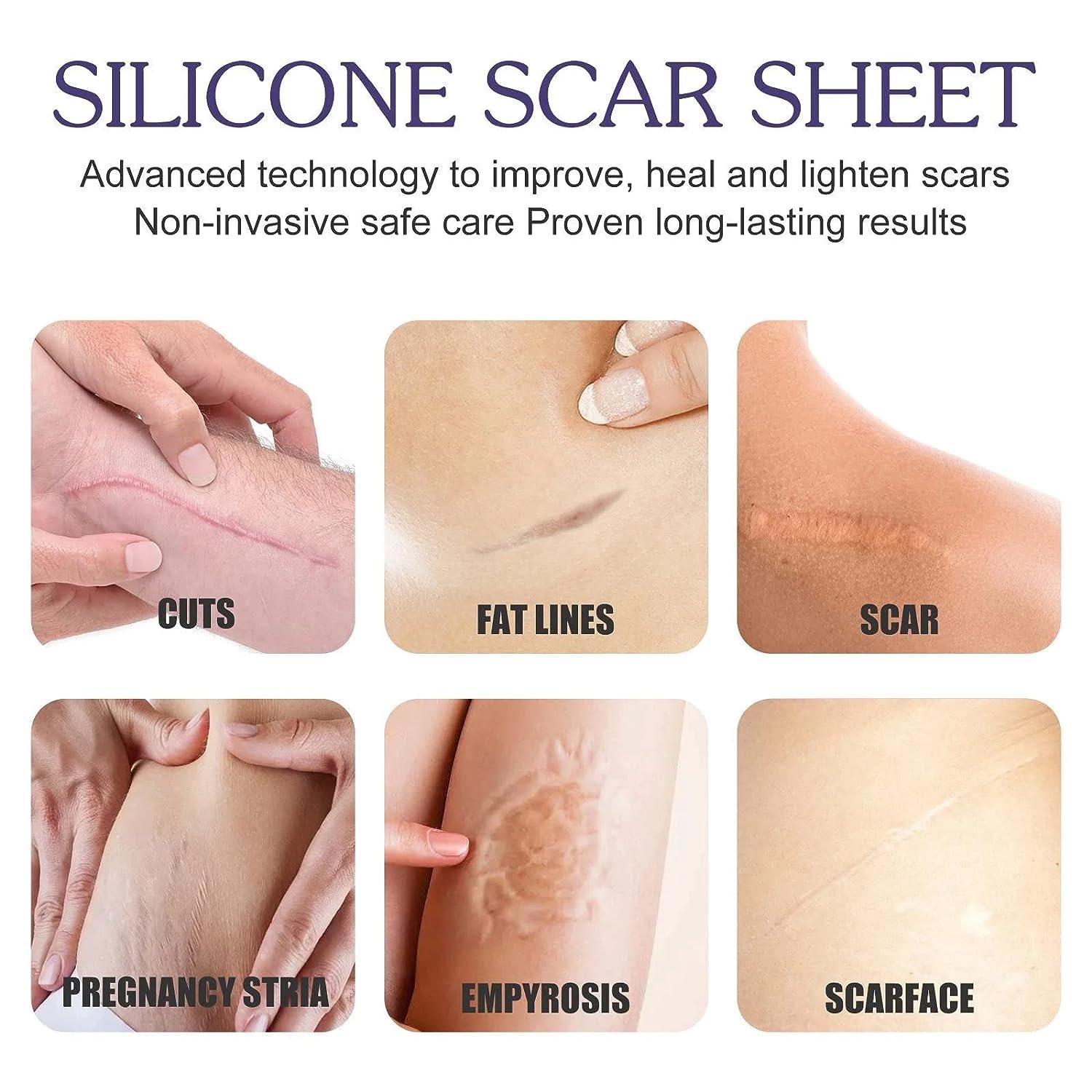 Silicone Scar Tape Roll, Silicone Scar Sheets, Scar Silicone Strips (1.6”  x120”Inch - 3M), Easy-Tear Gel Tape For Scar, Soft Silicone Scar for  Surgery