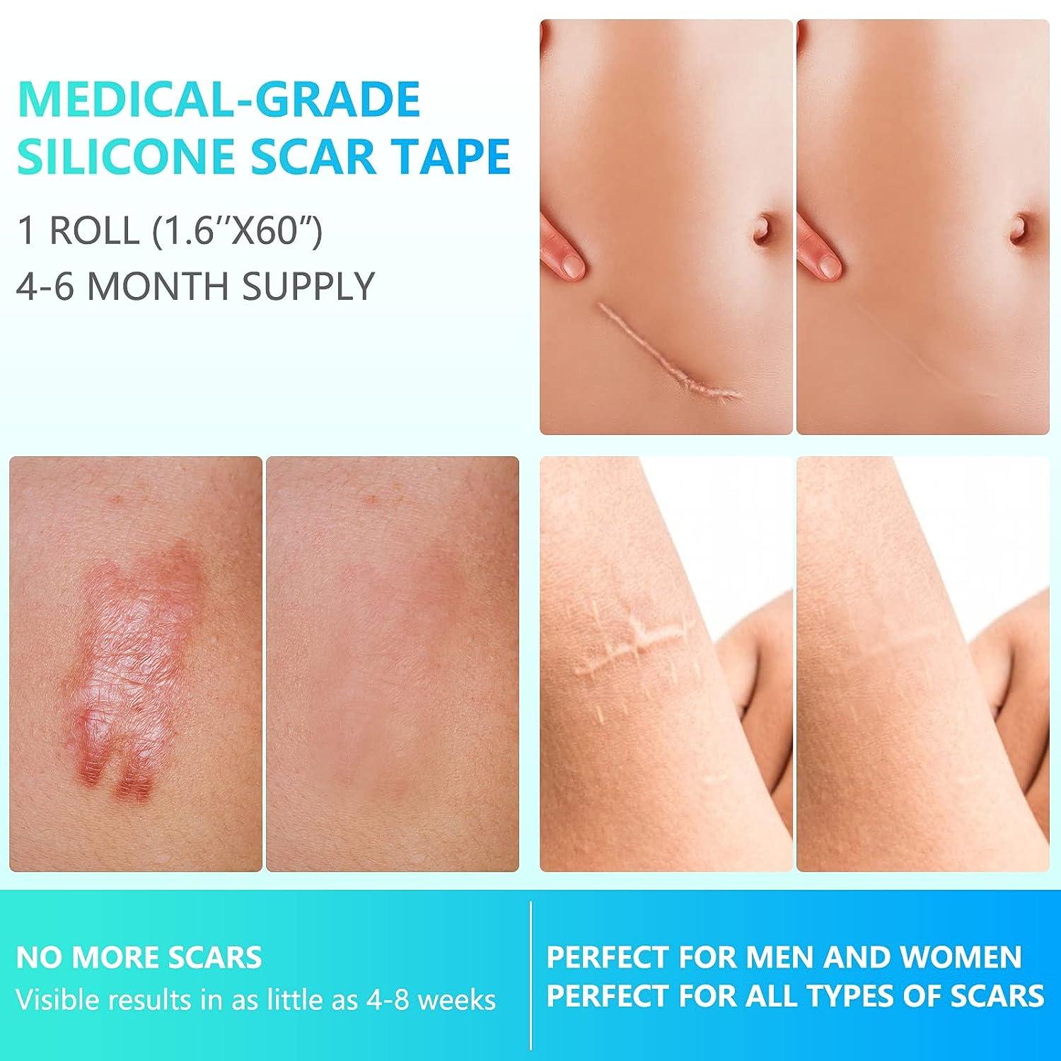 Silicone Scar Sheets, Silicone Scar Tape Roll 1.6 x 60(4 Month Supply),  Reusable And Effective Scar Removal Silicone Scar Strips For Scars Caused  By C- Section, Burn Scars, Surgery, Acne : 