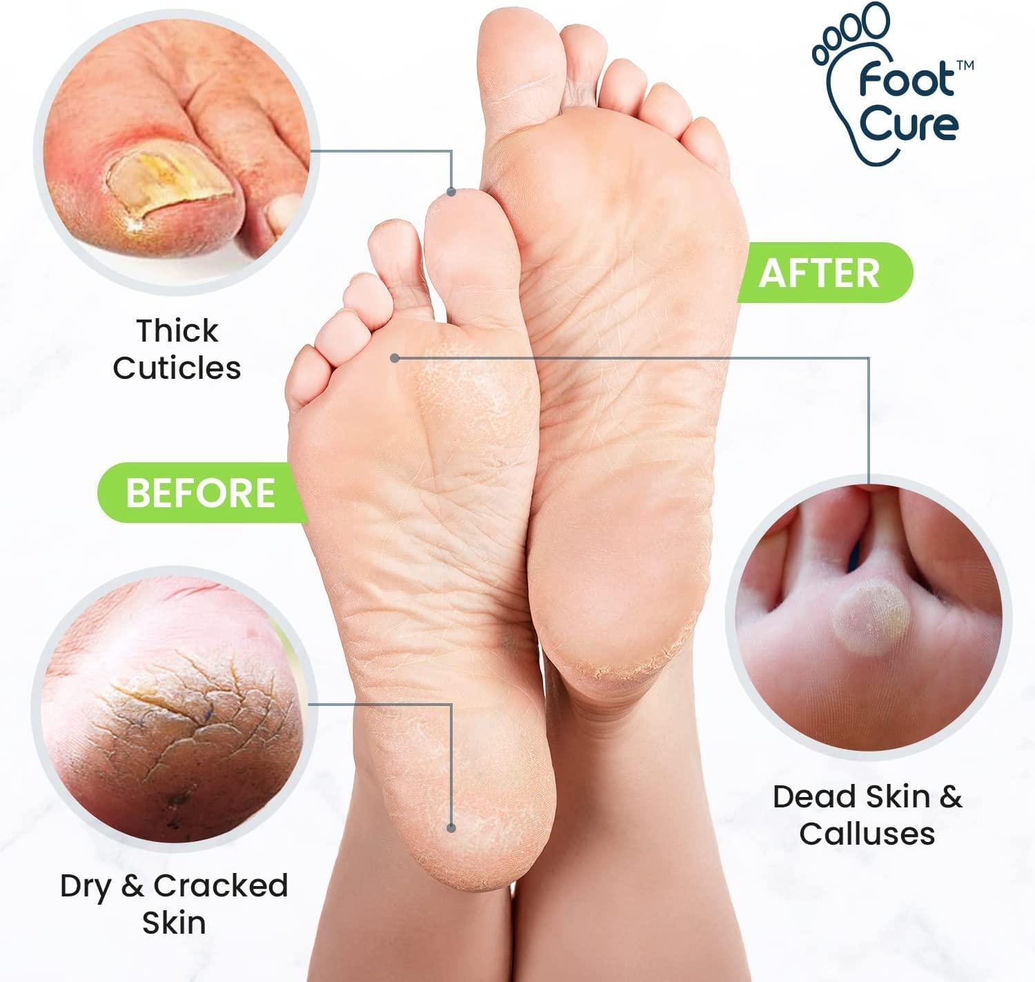 Top 4 Methods of Foot Callus Removal