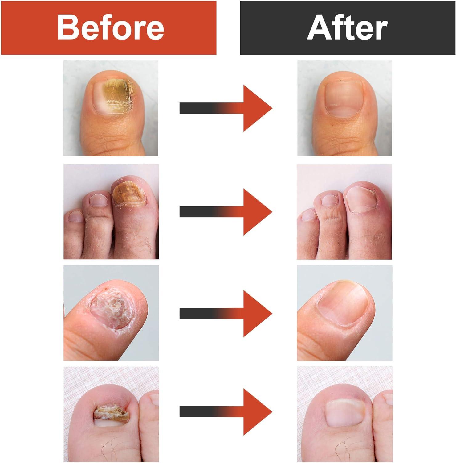 Nail Infection Treatment Gurgaon | Ingrown Nail Removal Surgery