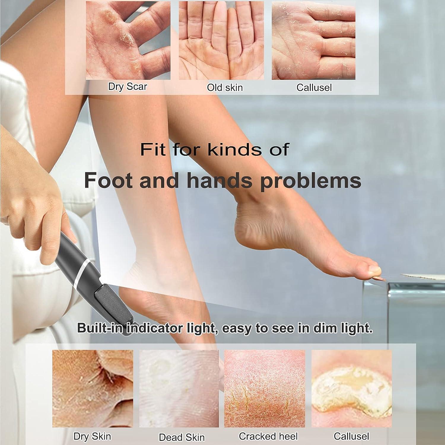 Electric Foot Callus Remover, Rechargeable 17 in 1 Foot File