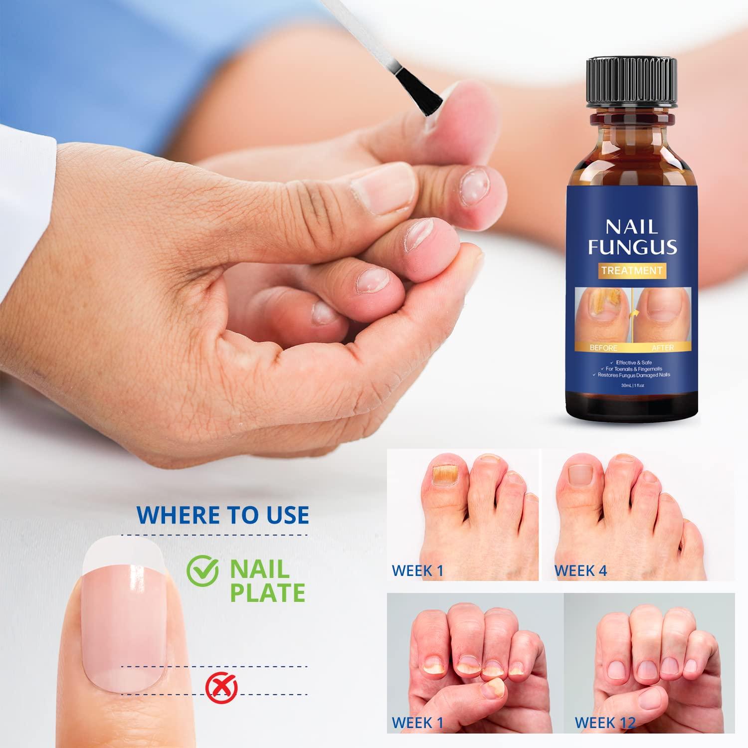 Toenail Fungus: What Is It, How to Prevent and Treat It | NYC