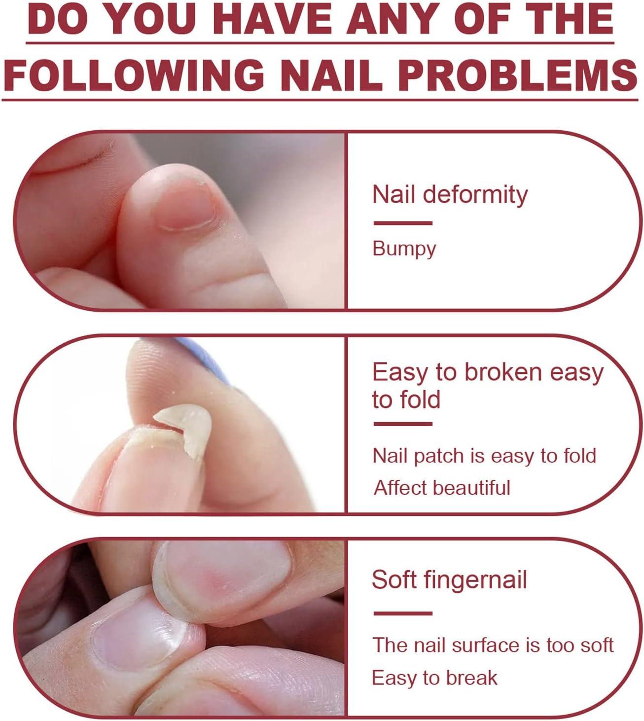 If Your Nails Break Easily, You May Be Dealing With 'Eggshell Nails'