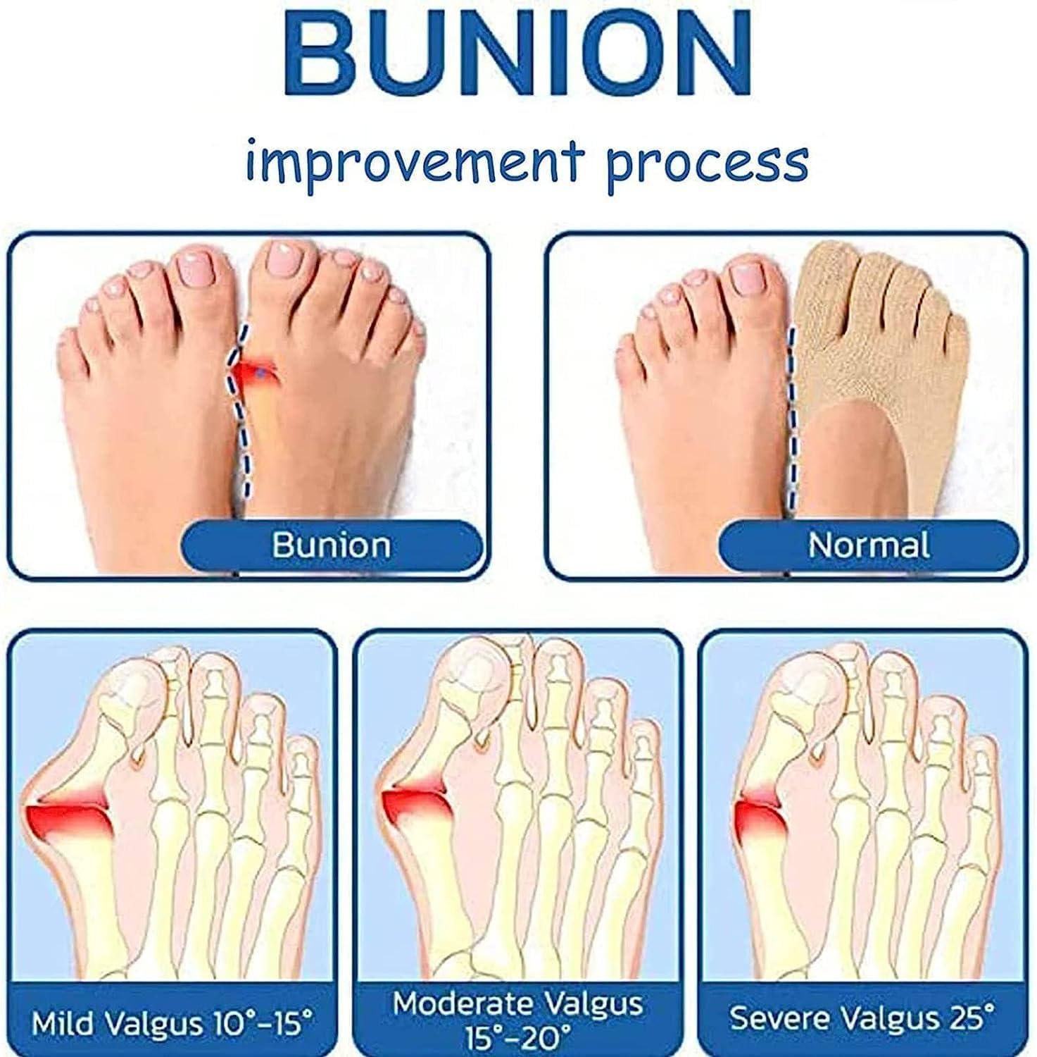 Orthoes Bunion Relief Socks Sock Align Toe Socks for Bunion Anti Bunions  Socks Bunion Relief Socks Split Toe Orthopedic Compression Bunions Socks  (5pairs)