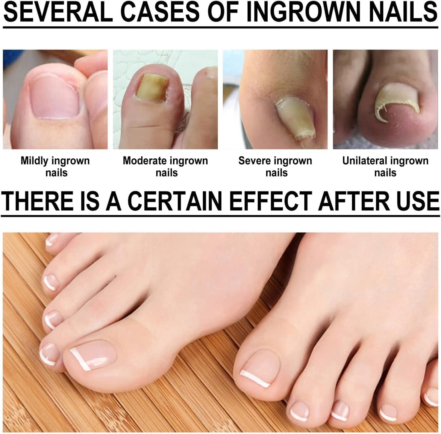 INGROWN TOENAIL TREATMENT - Foot HQ Podiatry | Foot & Ankle Specialists