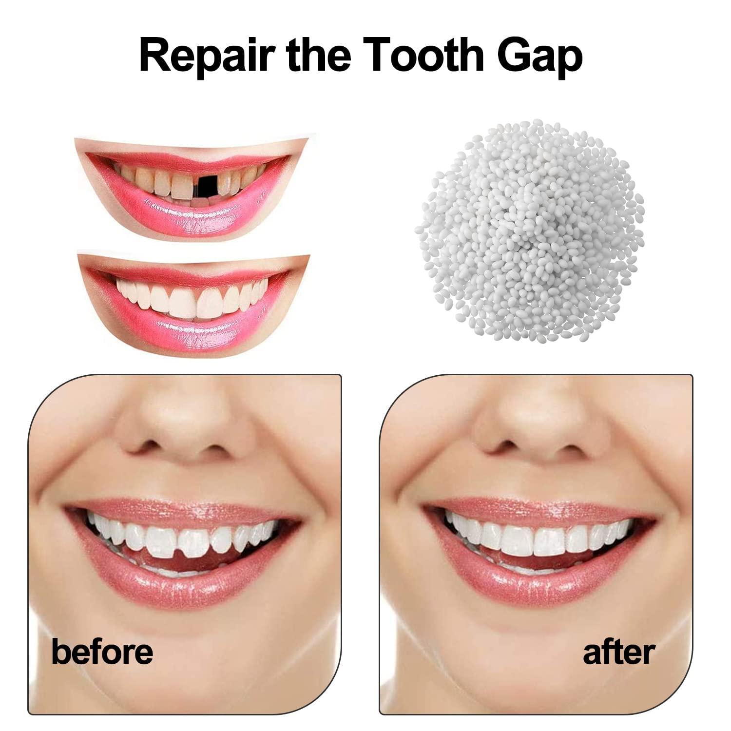 Teeth Repair Kit, Temporary False Teeth, Do it Yourself Thermal