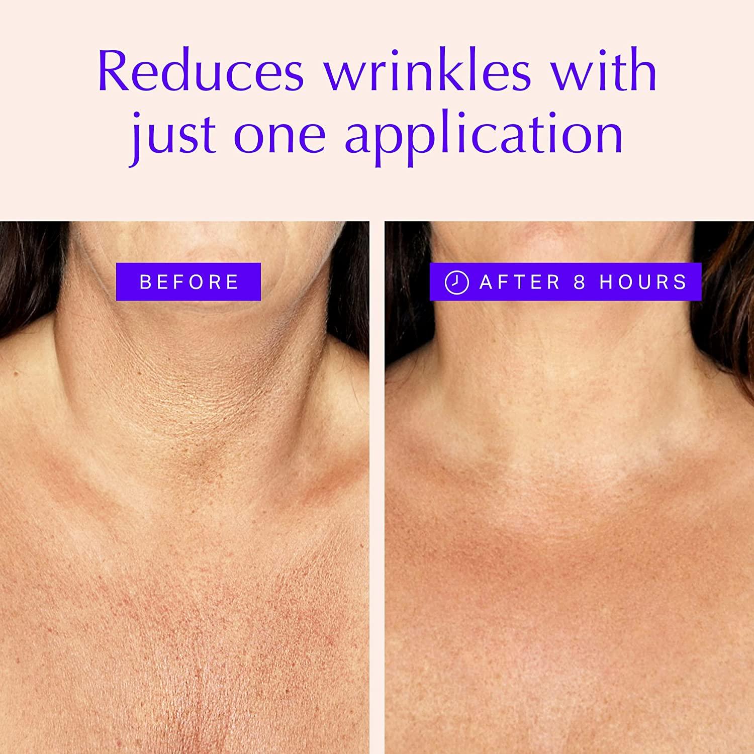 Skin tightening for the delicate neck, décolletage and bust area