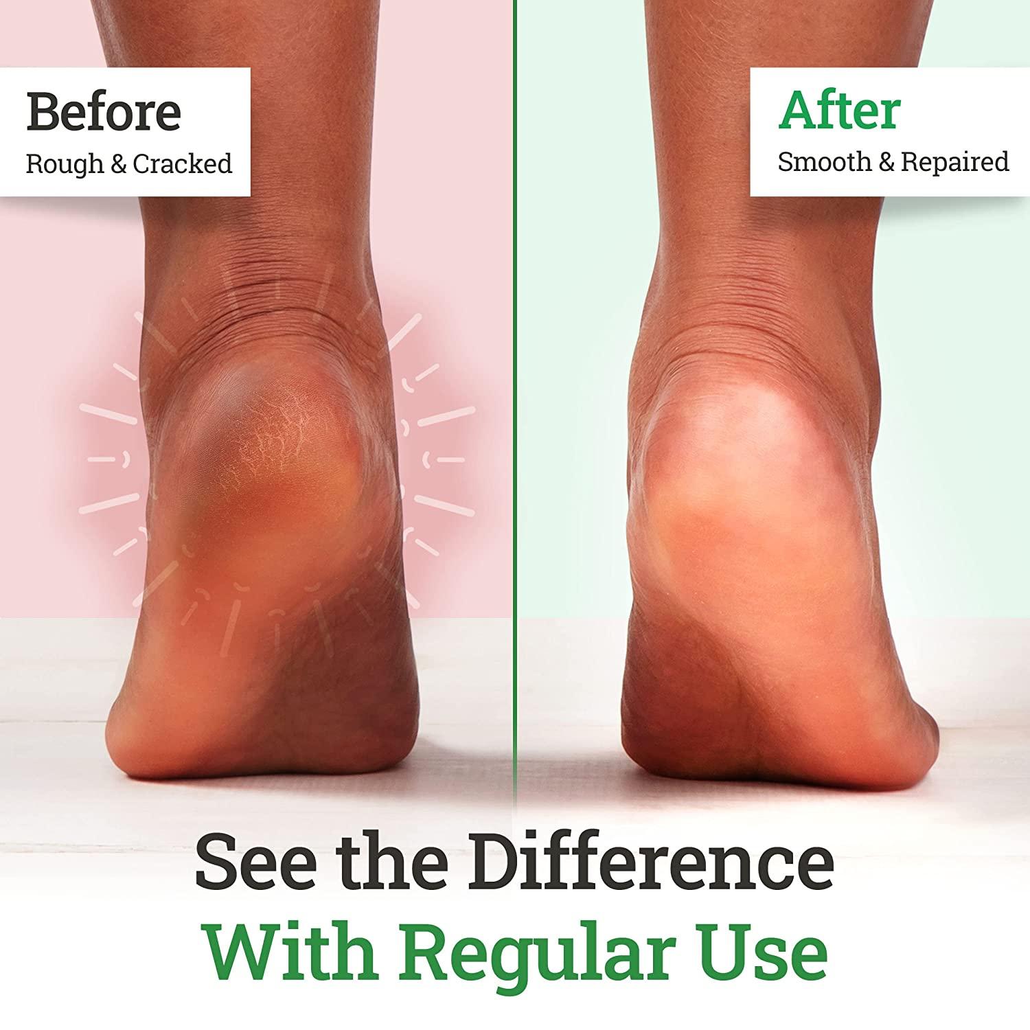 Say Goodbye to Dry Skin on Feet and Get your Feet Beautiful! - Amope US