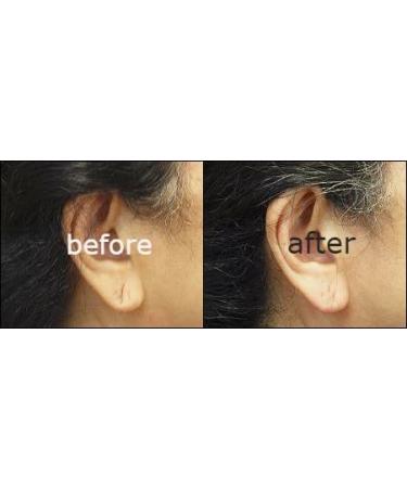 Miracle Stretched earlobe Corrector shrinking oil fix torn and stretched  piercing hole no more ear lobe support patches for earrings Miracle Ear Lobe  - Yahoo Shopping