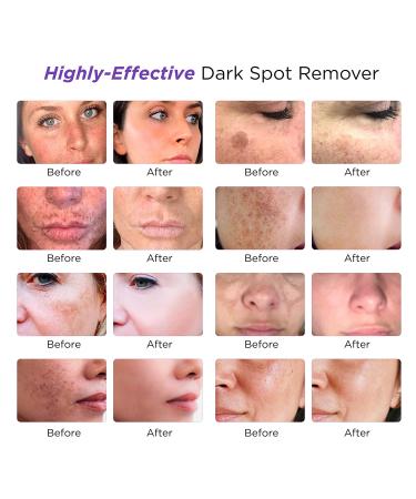 Dark Spot Remover for Face, Dark Spot Corrector for Face, Day & Night Sun  Spots, Age Spot and Freckle Remover with Vitamin C & Hyaluronic Acid ,  4-Butylresorcinol, Kojic Acid, Lactic Acid